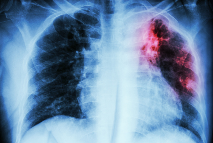 Altos indices de tuberculosis en Cancún