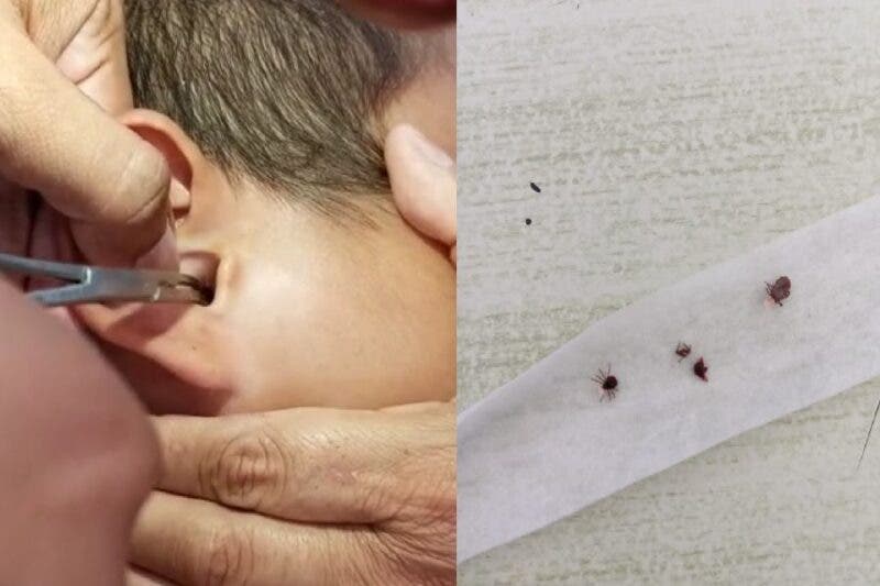 Encuentran garrapatas en oído de un niño de Progreso