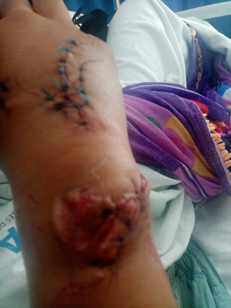 Joven atacado por un tiburón en Mahahual necesita cirugía o pierde el miembro