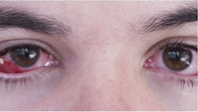 Se prevé brote de conjuntivitis en Quintana Roo