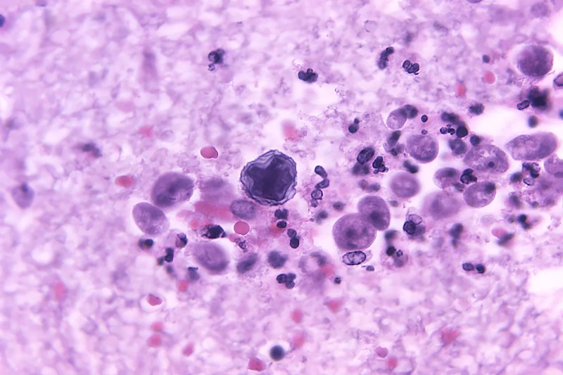 Un hombre de 33 años sufrió una infección por meningitis amebiana primaria, que es mortal en el 97%